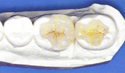 Вкладки зубов на слепке